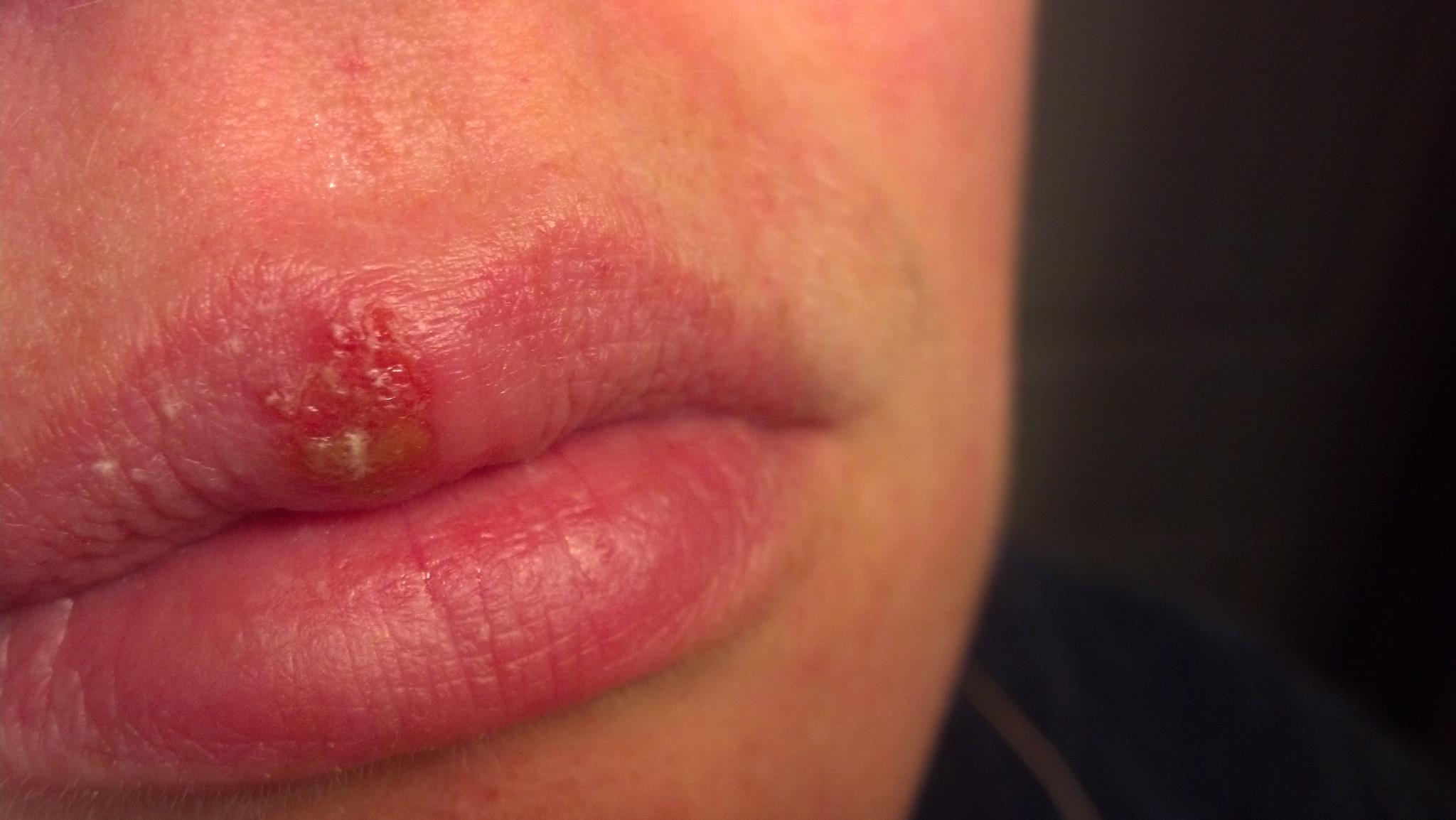 cold sore images #9
