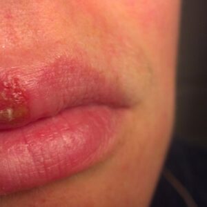 My Embarrassing Enemy: Cold Sores (and how to stop them!)