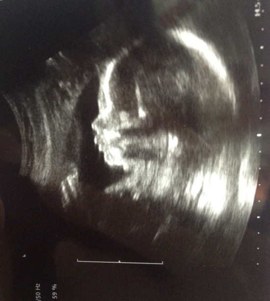 Baby S (anomaly scan) (2)