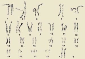 Karyotype of a female with Down syndrome. Photo courtesy of the National Down Syndrome Society 