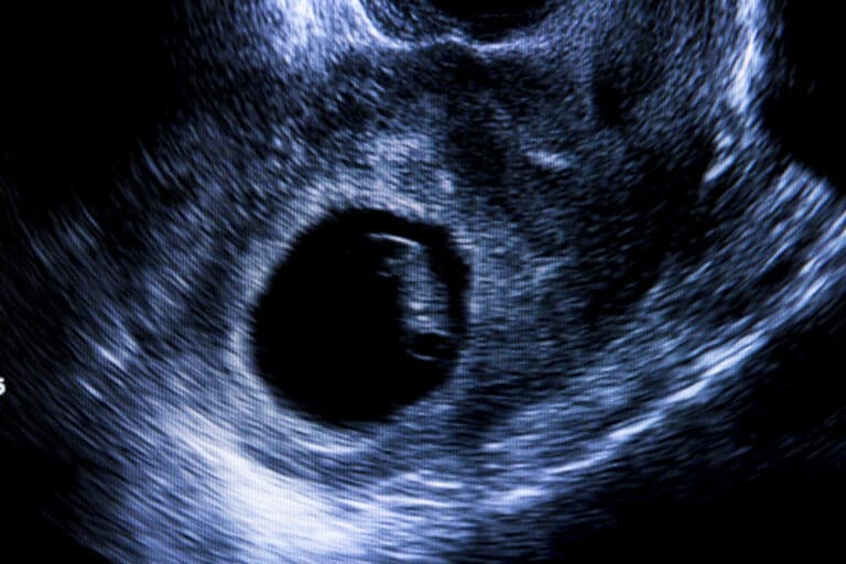 Early ultrasound of baby