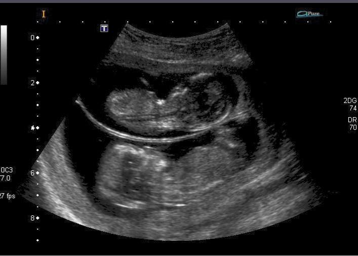 Sonogram photo of twin pregnancy