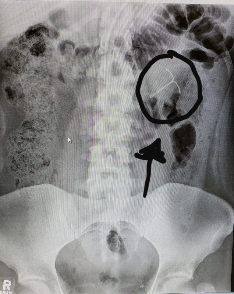 IUD on x-ray image of woman's abdomen