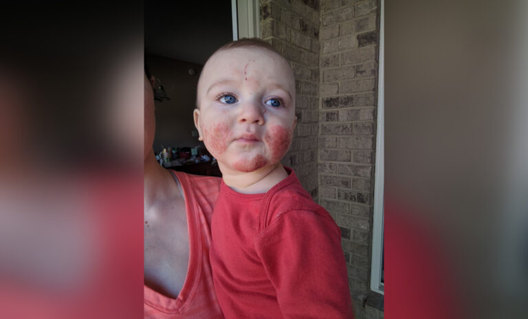 Little boy with rash on cheeks, color photo