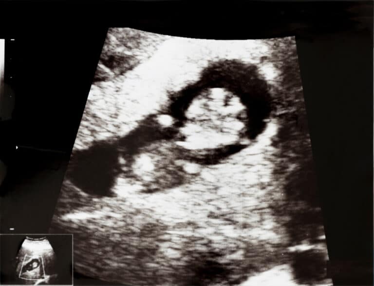 Ultrasound photo