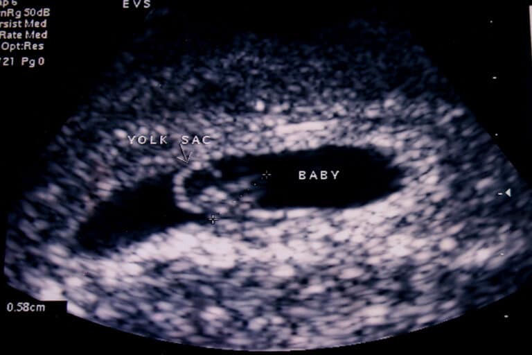 Early ultrasound