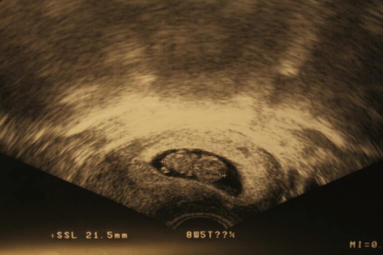 Early pregnancy ultrasound
