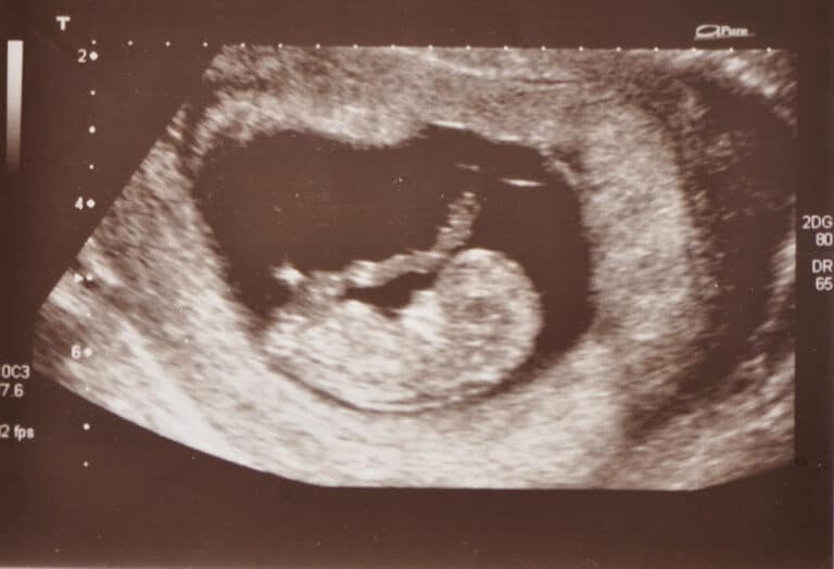 ultrasound of baby