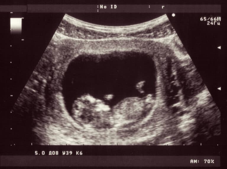Early sonogram image of baby