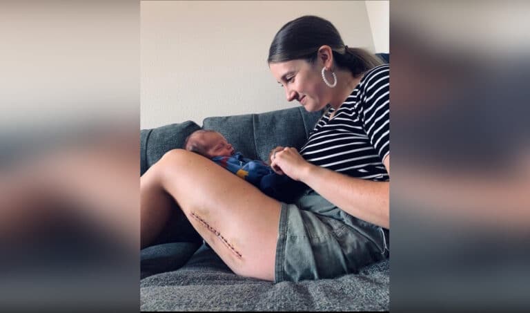 Mother holding baby on lap with large scar on leg