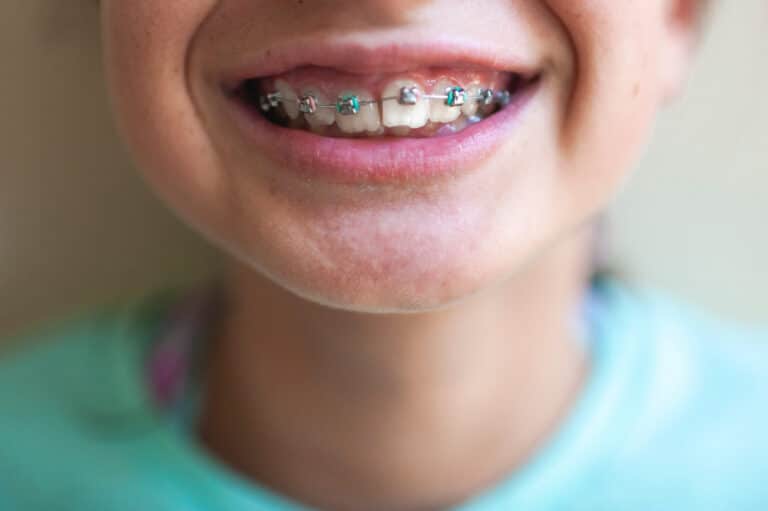 Tween close up of braces on teeth