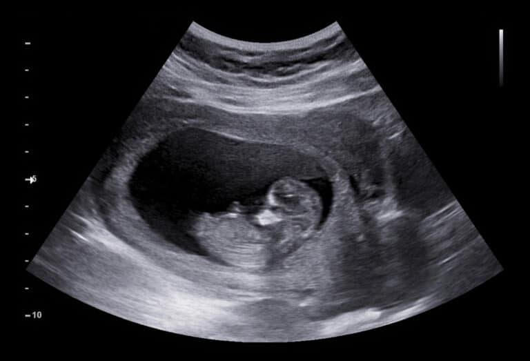 Early ultrasound photo of baby in womb