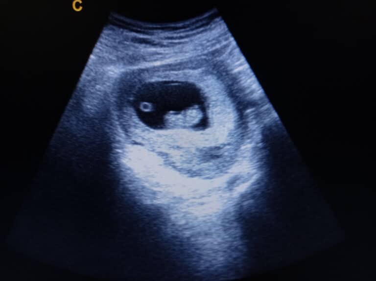 first trimester ultrasound image of baby