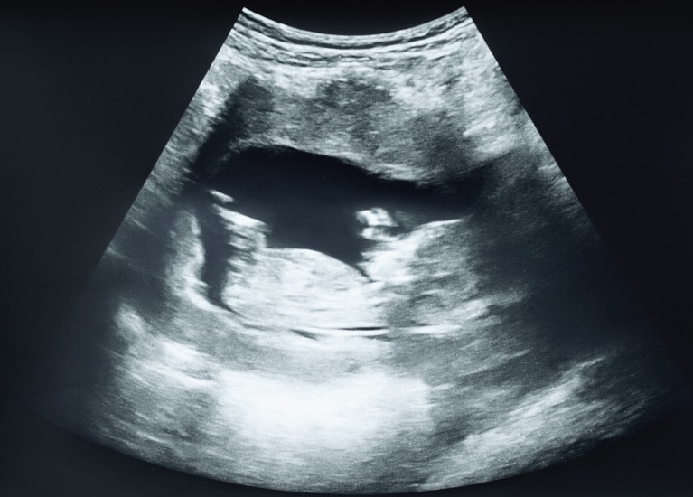 Ultrasound image of baby in second trimester