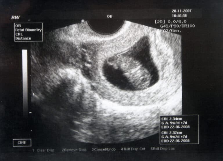 Early sonogram image