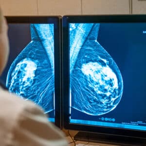 Why I Had My Benign Breast Lumps Removed